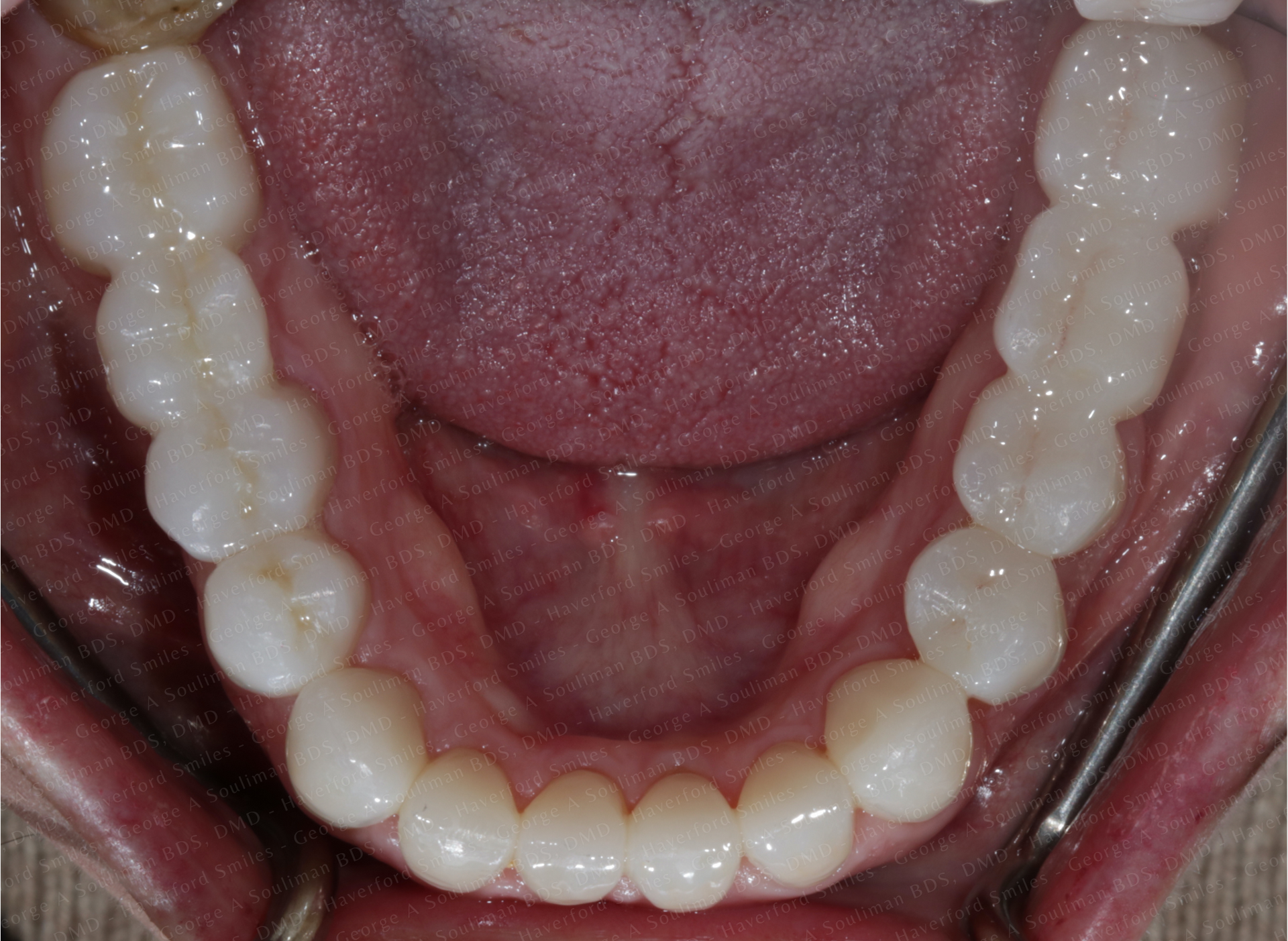 Full mouth rehab with Ceramic Crowns & Ceramic Bridges after