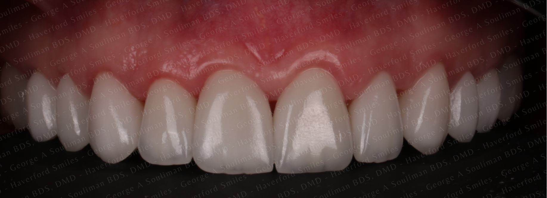 Full mouth rehab Ceramic Veneers & Ceramic Crowns after