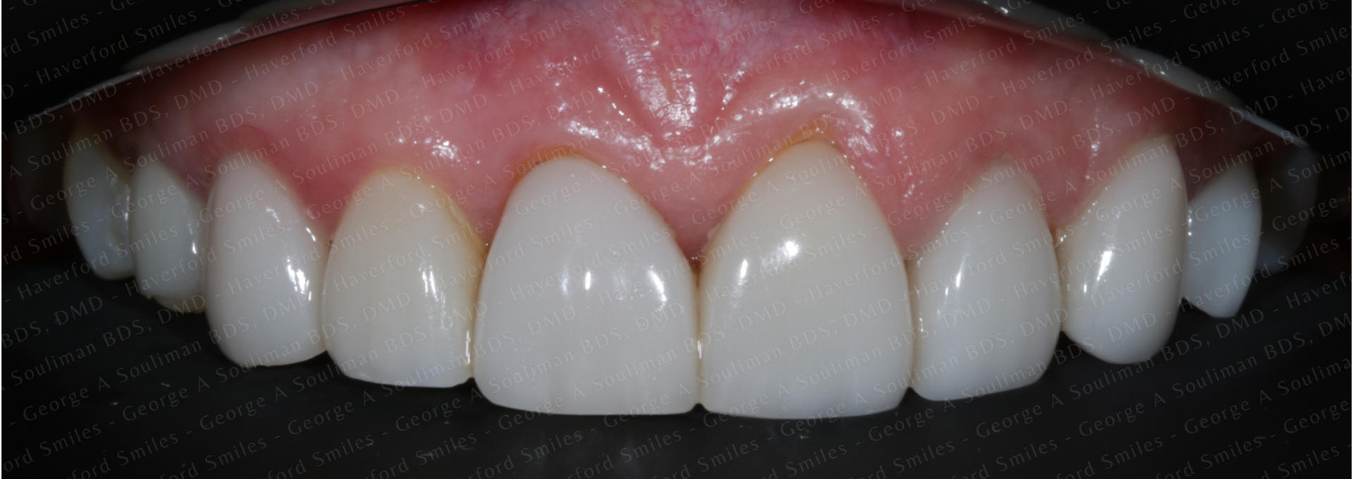 Full mouth rehab Ceramic Veneers & Ceramic Crowns before