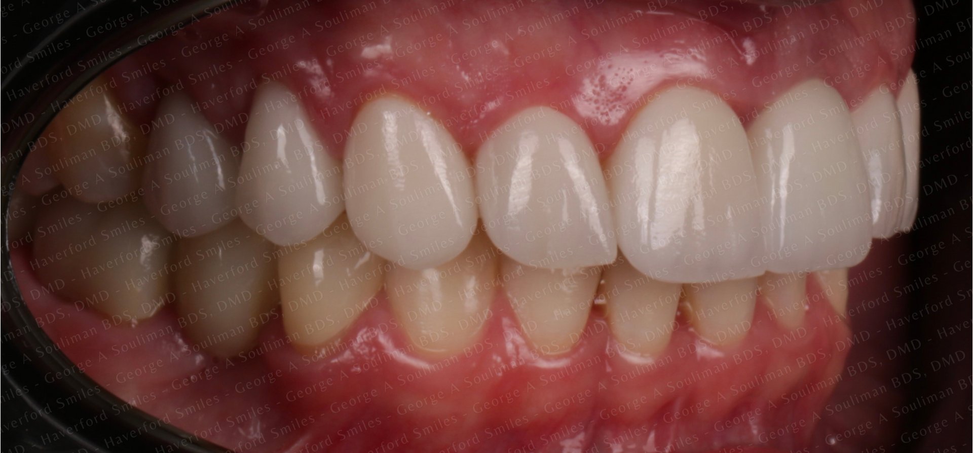 Full mouth rehab Ceramic Veneers, Ceramic Crowns & Ceramic Bridge after