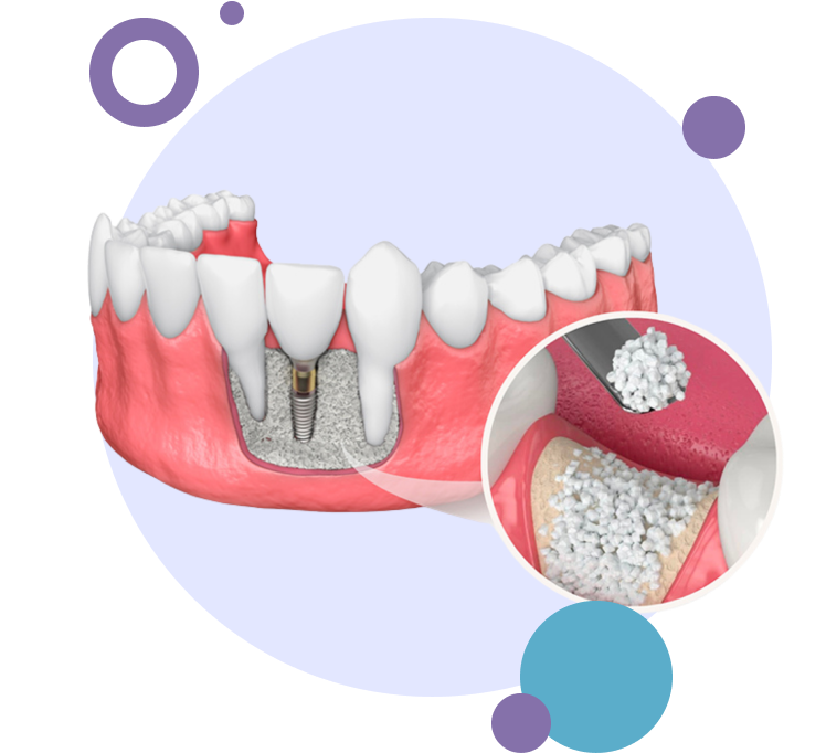 Image of how bone grafting in the jaw is performed