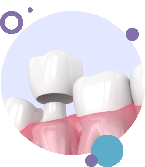Image of a tooth receiving an dental crown