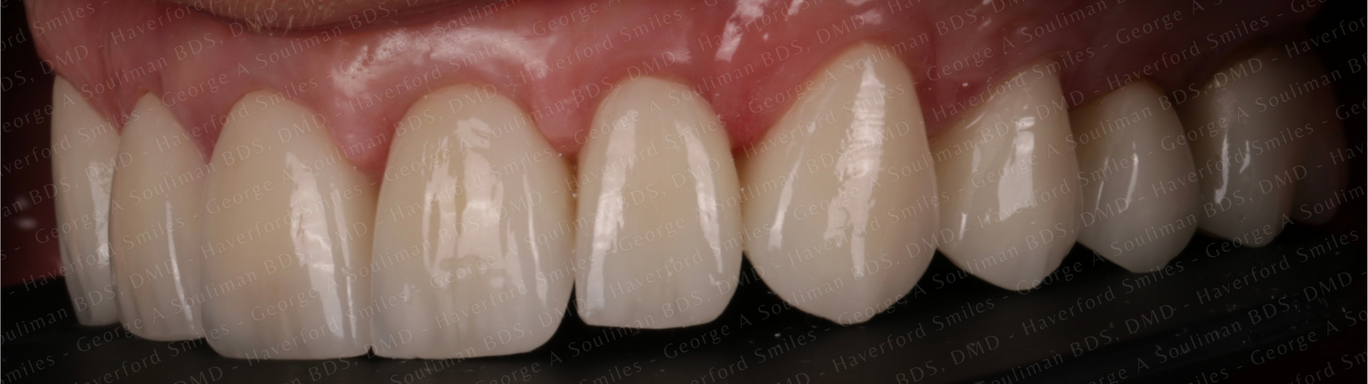 Maxillary arch rehab Upper Ceramic Crowns after
