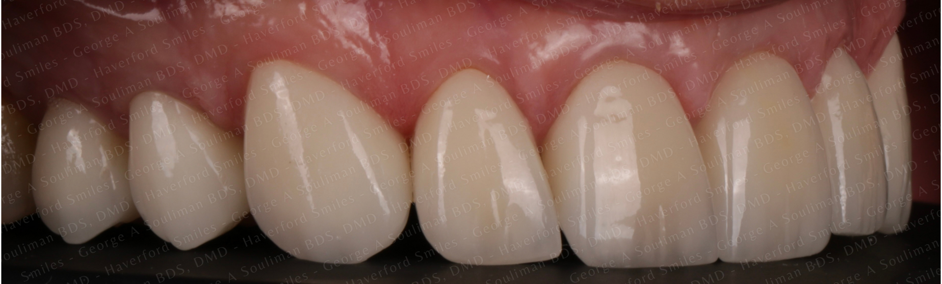 Maxillary arch rehab Upper Ceramic Crowns after