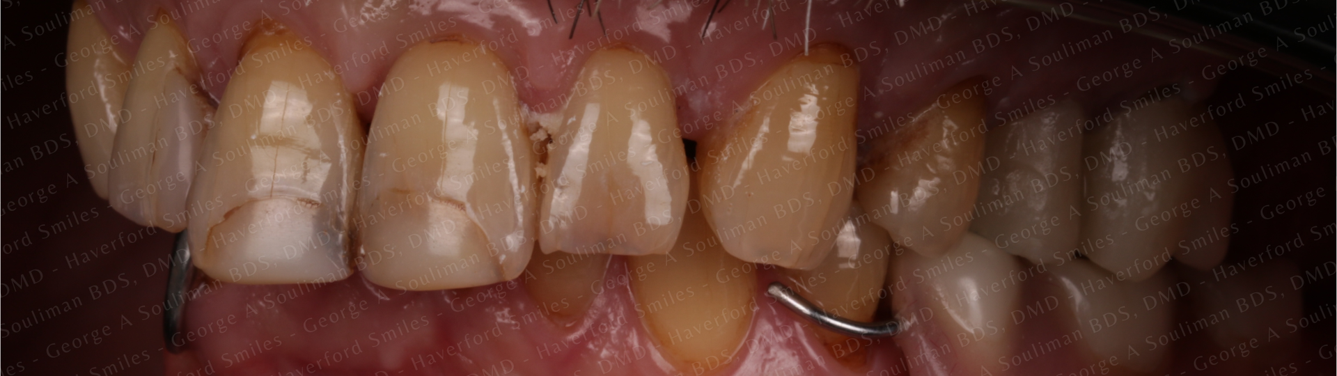 Maxillary arch rehab Upper Ceramic Crowns before