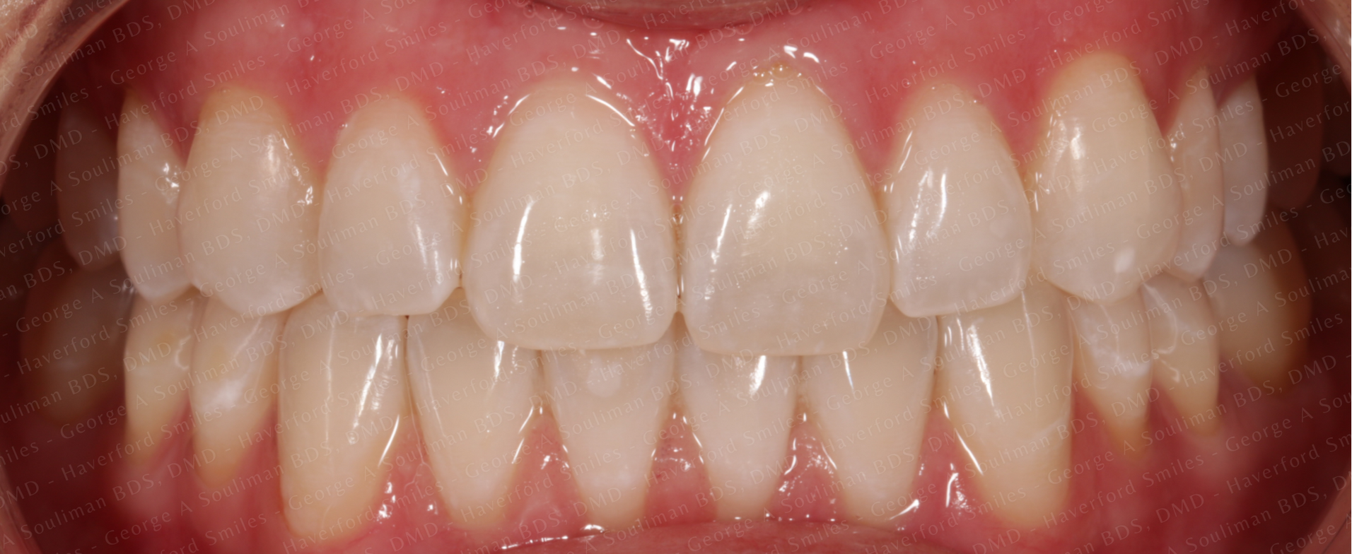 Zoom whitening after