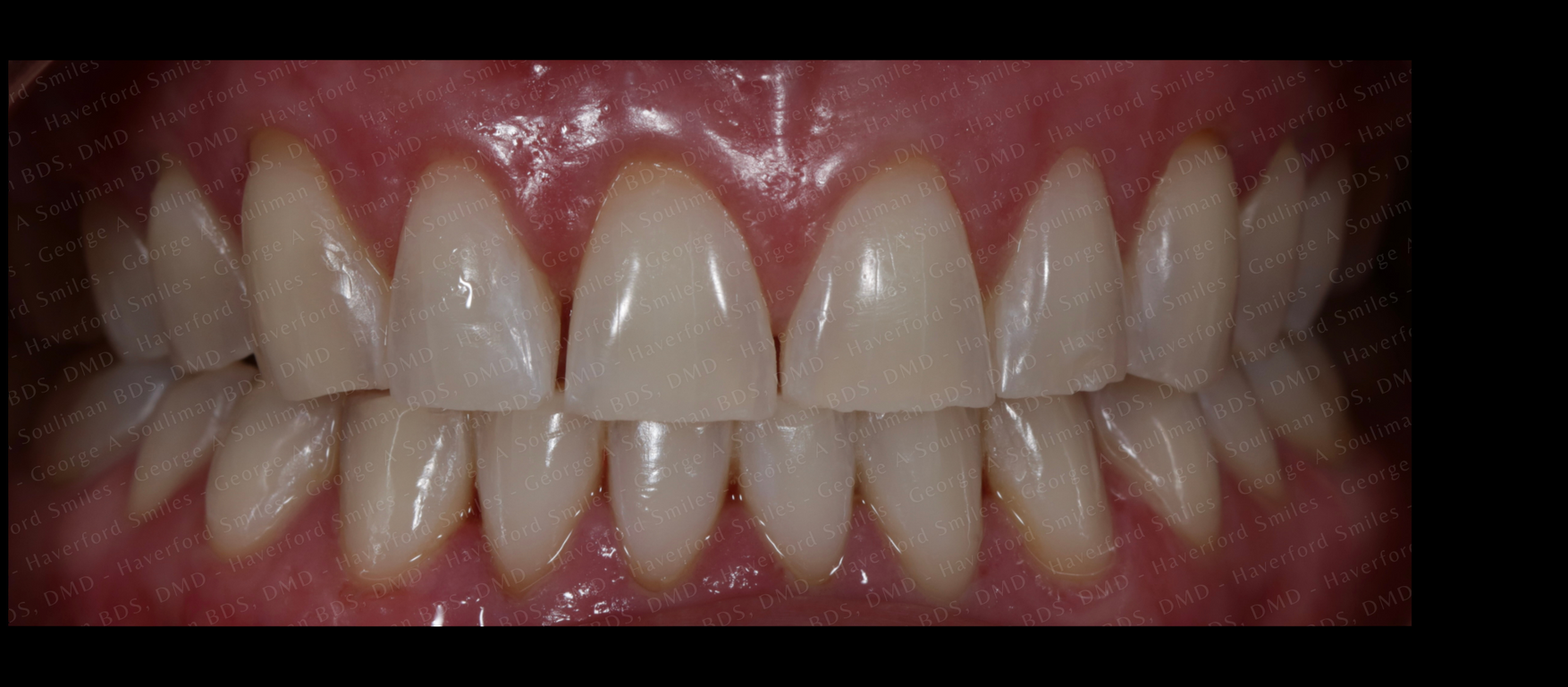 Zoom whitening after