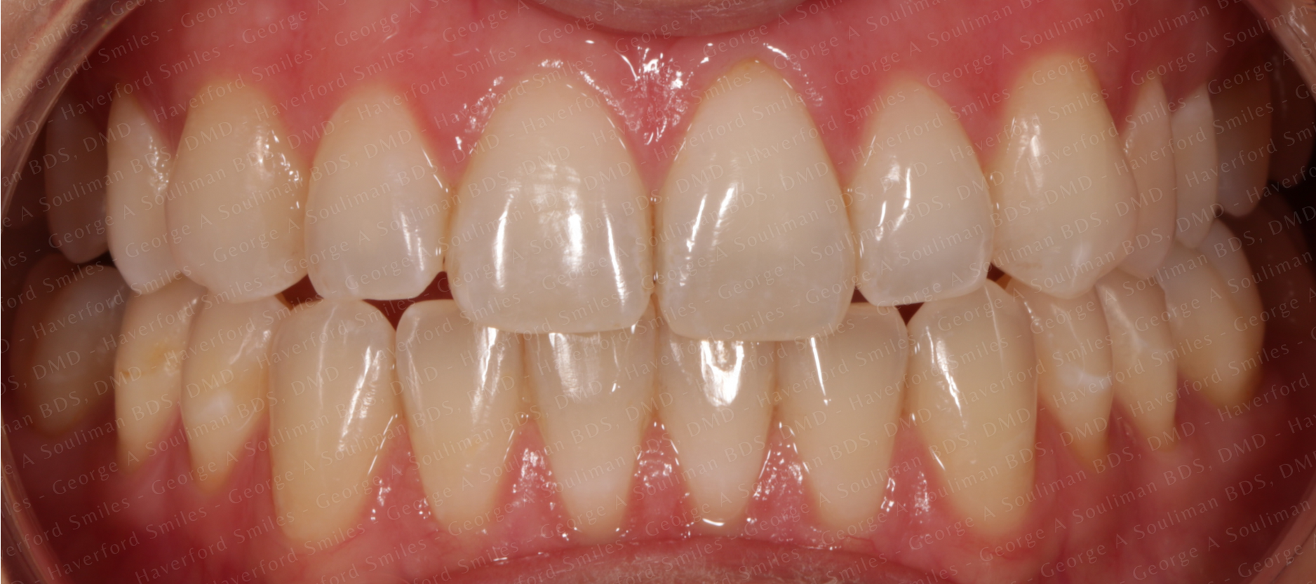 Zoom whitening before