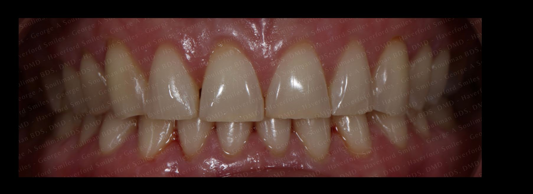 Zoom whitening before