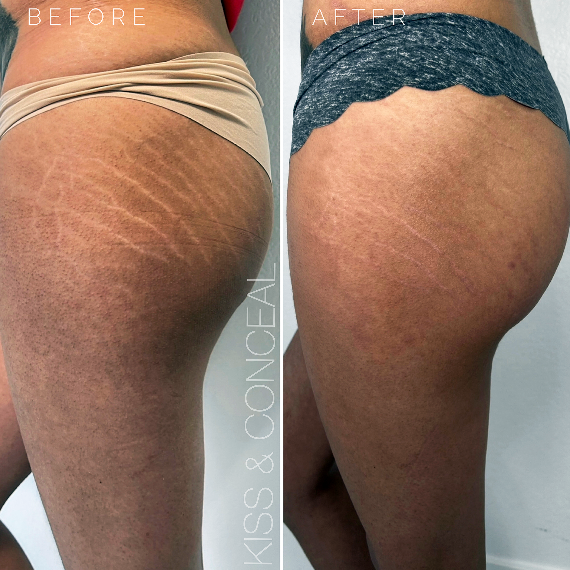 Stretch Mark Camouflage Stretch Mark Camouflage