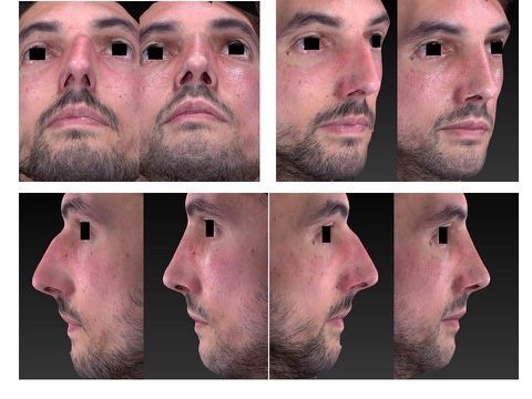 RINOPLASTIA