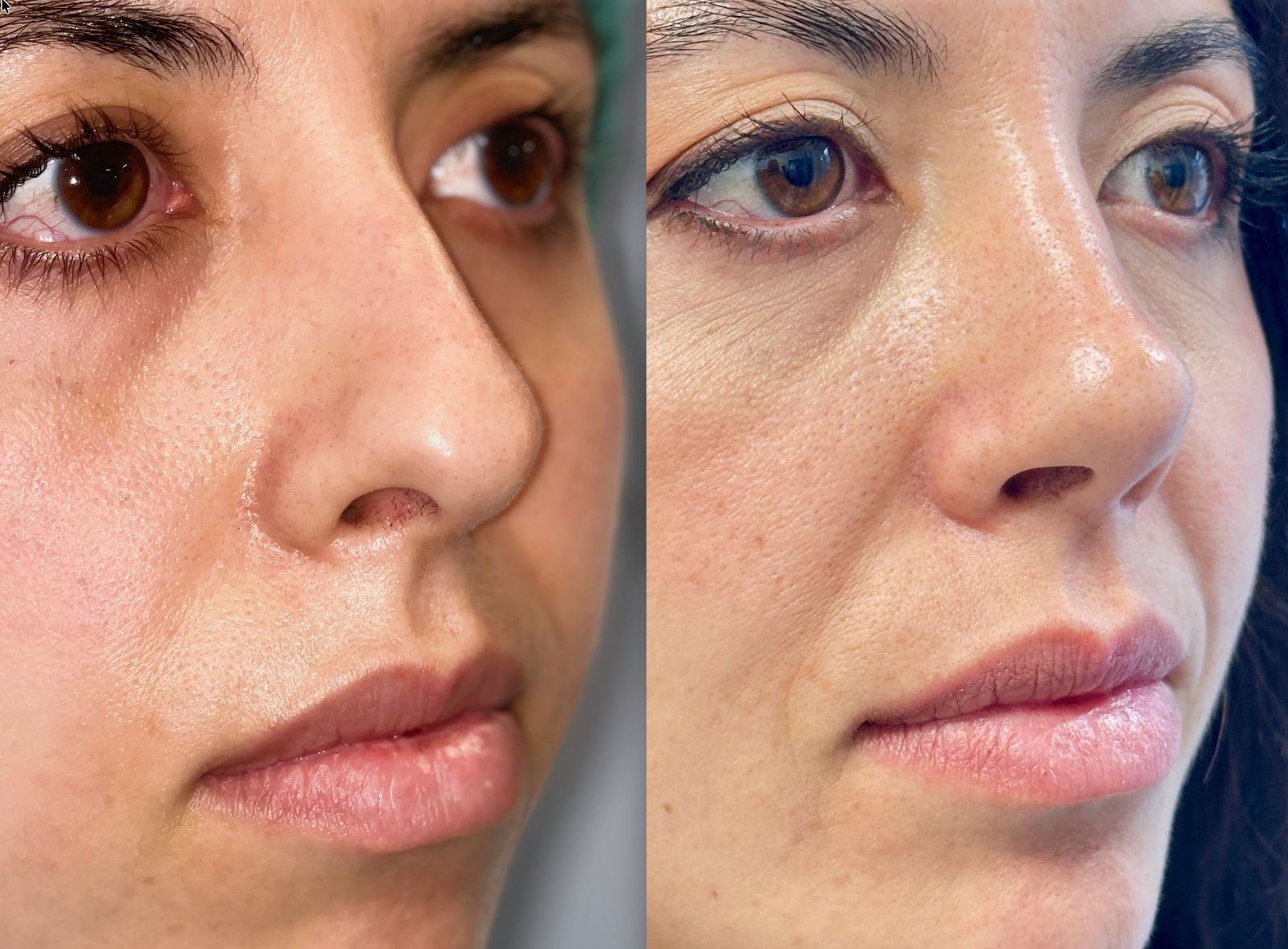 RINOPLASTIA