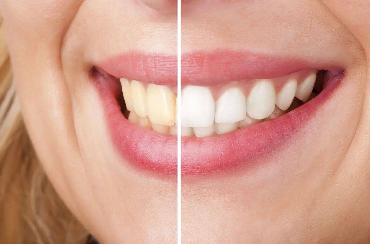 whitening