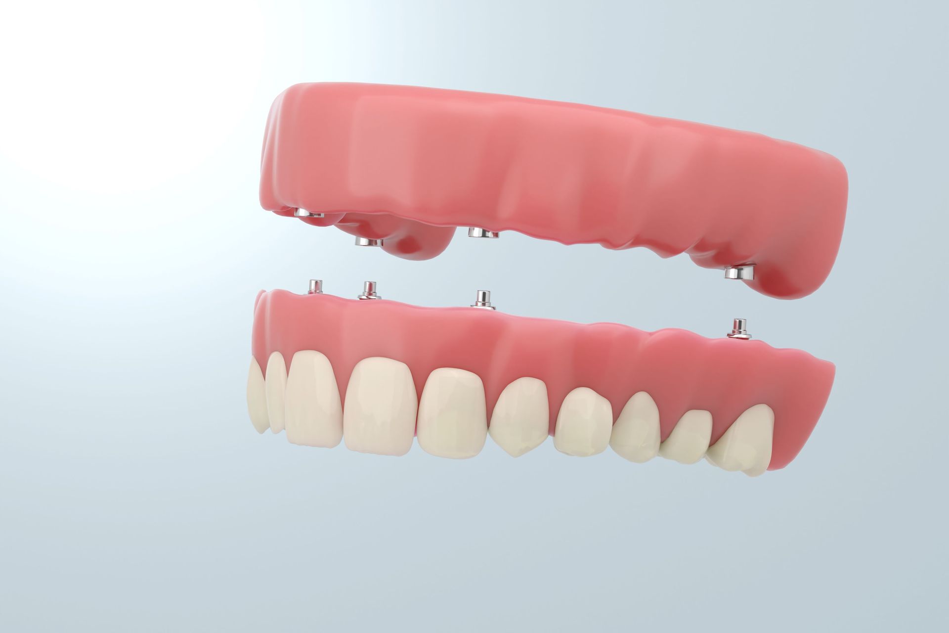 A Close Up of a Model of a Denture With Dental Implants — The Denture Kitchen in Maroochydore, QLD