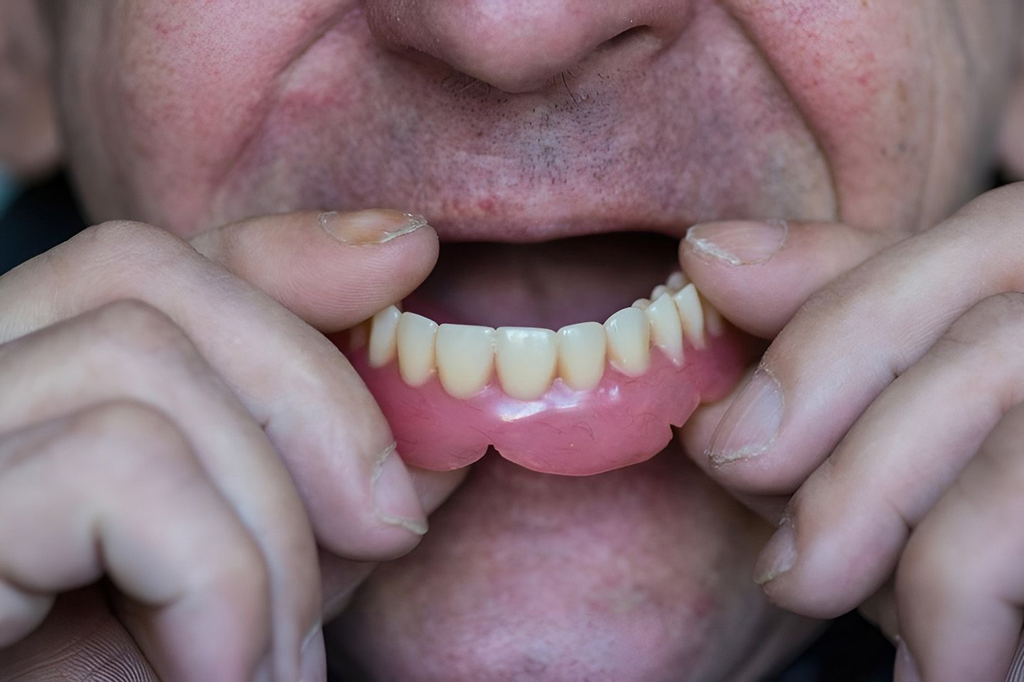 Person Holding A Dentures Plate Near Their Mouth