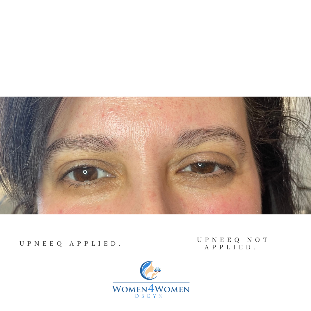 UpNeeq before and after patient photos