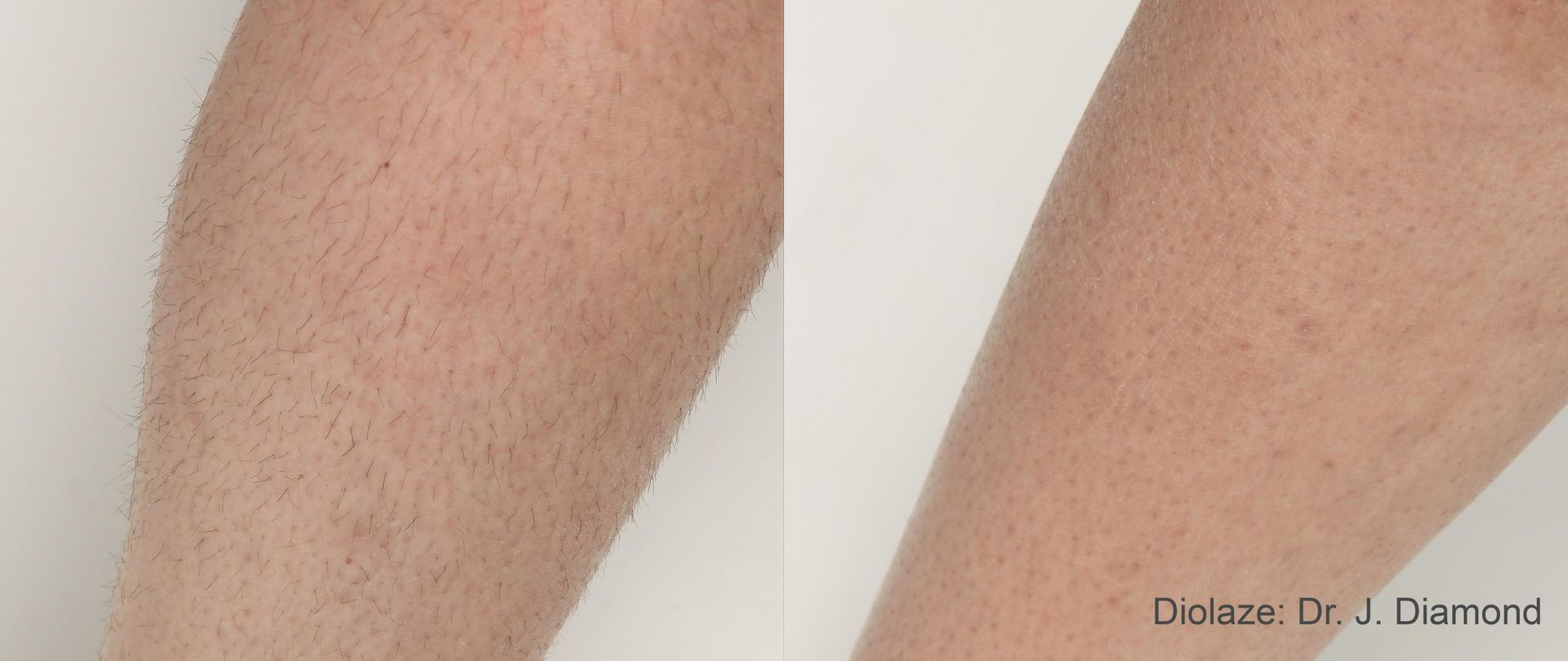 Before and After DIOLAZExl