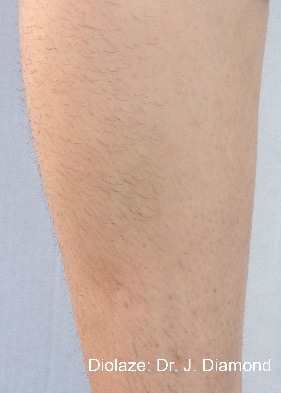 Before and After DIOLAZExl