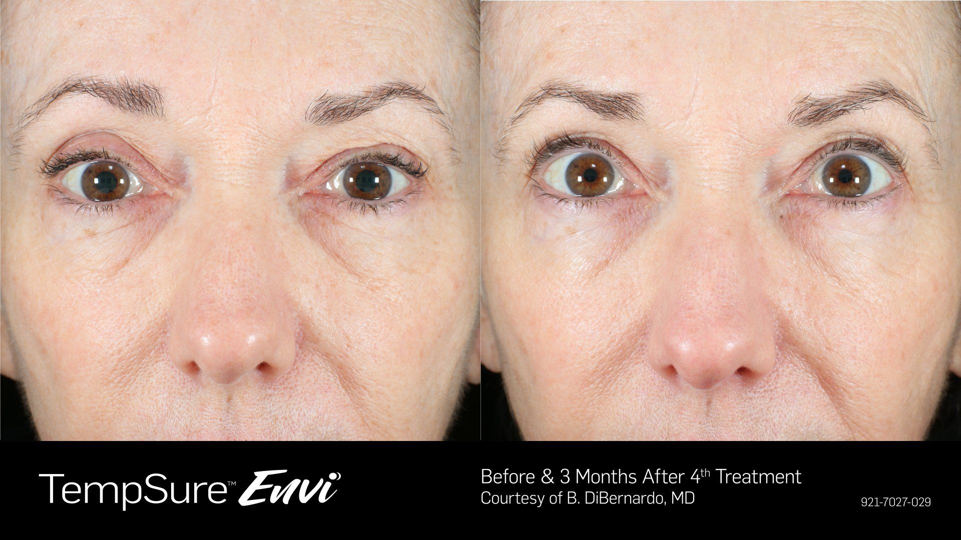 A before and after photo of a woman 's eyes