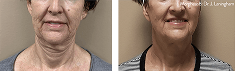 A before and after photo of a woman 's neck and face.