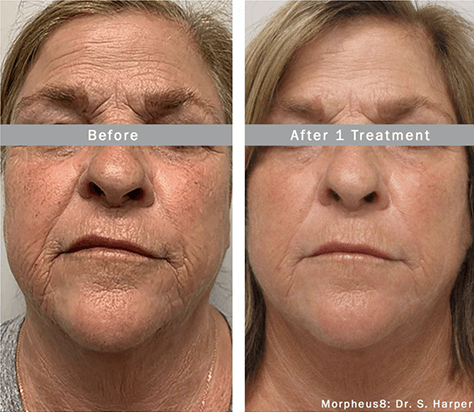 A before and after photo of a woman 's face
