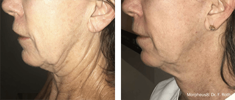 A before and after photo of a woman 's neck and face.
