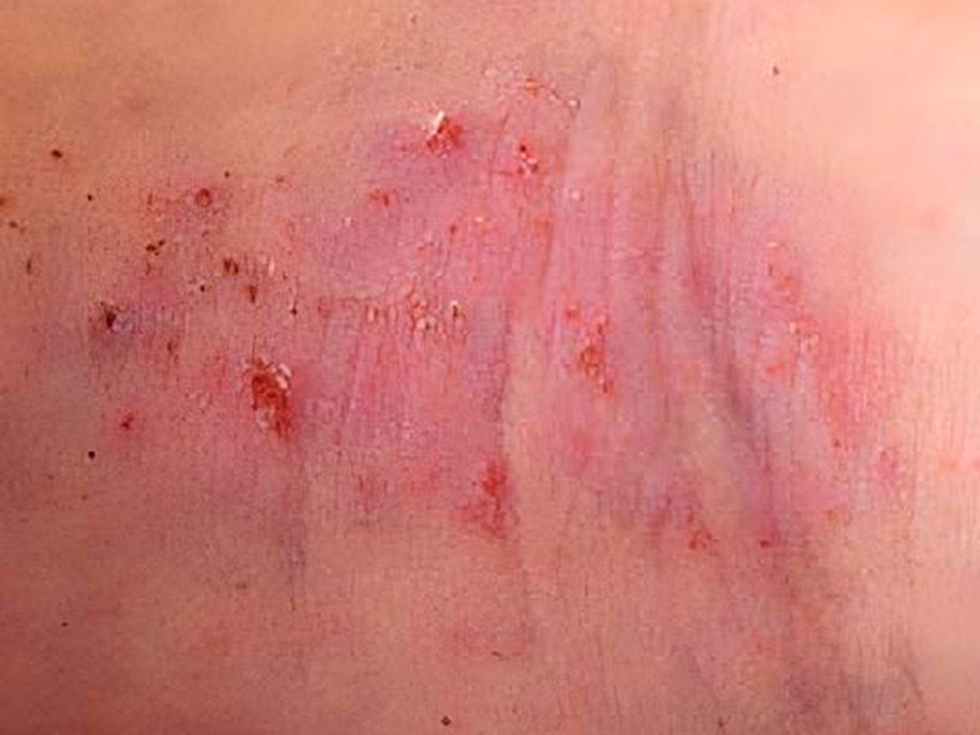 Visita dermatologica eczema e dermatiti