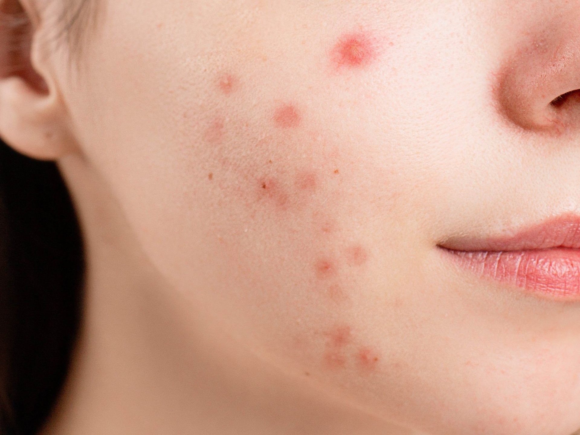 Visita dermatologica acne