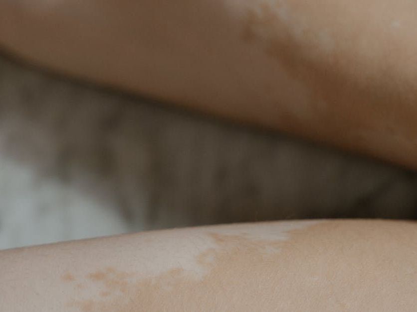 Visita dermatologica vitiligine