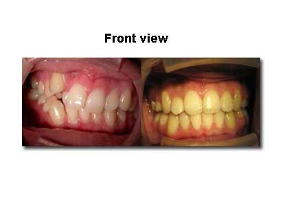 Front view of teeth showing crooked and discolored teeth.
