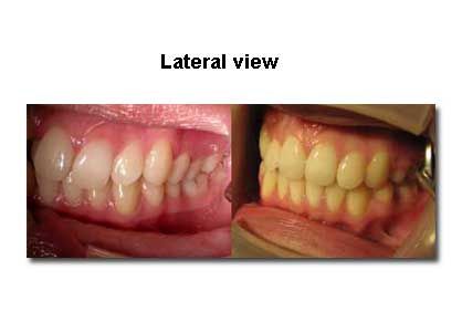 Lateral view of teeth, showing side profile of upper and lower teeth, revealing the arrangement and condition of the teeth.