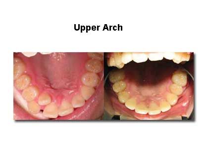 Two views of upper teeth arch, showing all teeth in a mouth.
