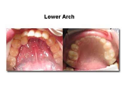 Two views of a person's lower dental arch, showing teeth and tongue; pink gums and white teeth.