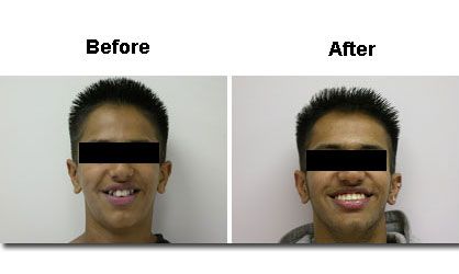 A before-and-after dental treatment comparison. The 