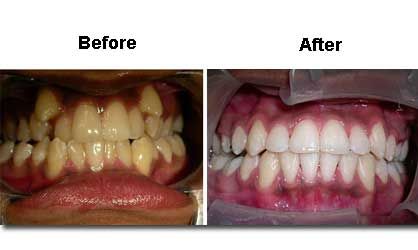 Side-by-side comparison shows stained teeth before and bright white teeth after a whitening procedure.