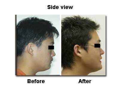 Side view comparison: Before and after jaw surgery. The 