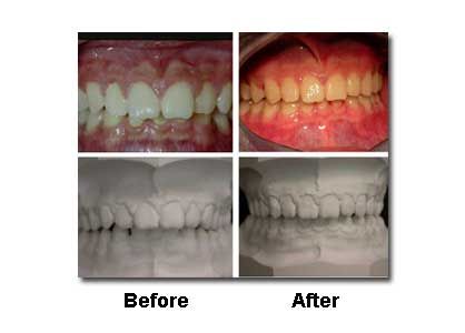 Before and after dental images of teeth. Top row: teeth; Bottom row: teeth molds.