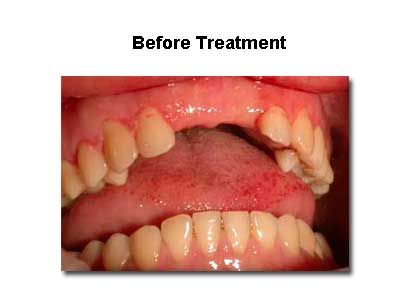 Mouth with missing and misaligned teeth, before dental treatment.