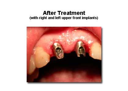 Close-up of a person's upper gumline with two metal dental implants visible, post-treatment.