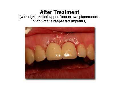 Close-up of a mouth showing two new front teeth crowns. Gum tissue around the crowns is visible.