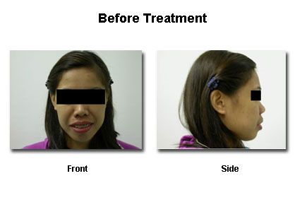 Front and side views of a person with braces, before treatment.