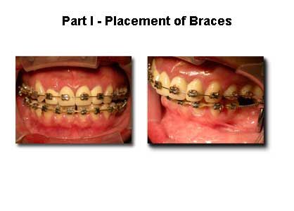 Two views of a mouth with metal braces on the upper and lower teeth.