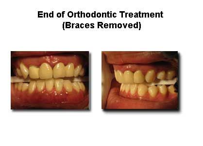 Comparison of teeth before and after orthodontic treatment; braces removed.