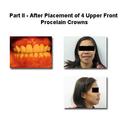 A person with new porcelain crowns, shown in mouth, full face, and side profile views.