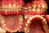 Four dental photos: front, side, and two views of the upper and lower teeth, showing irregular and crowded teeth.