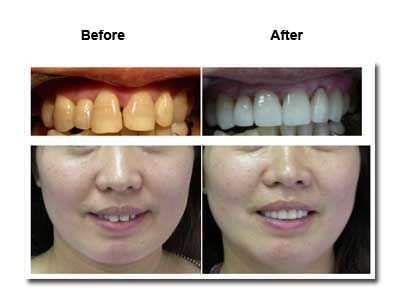 Comparison of teeth and face before and after cosmetic dental work, showing whiter teeth and improved smile.