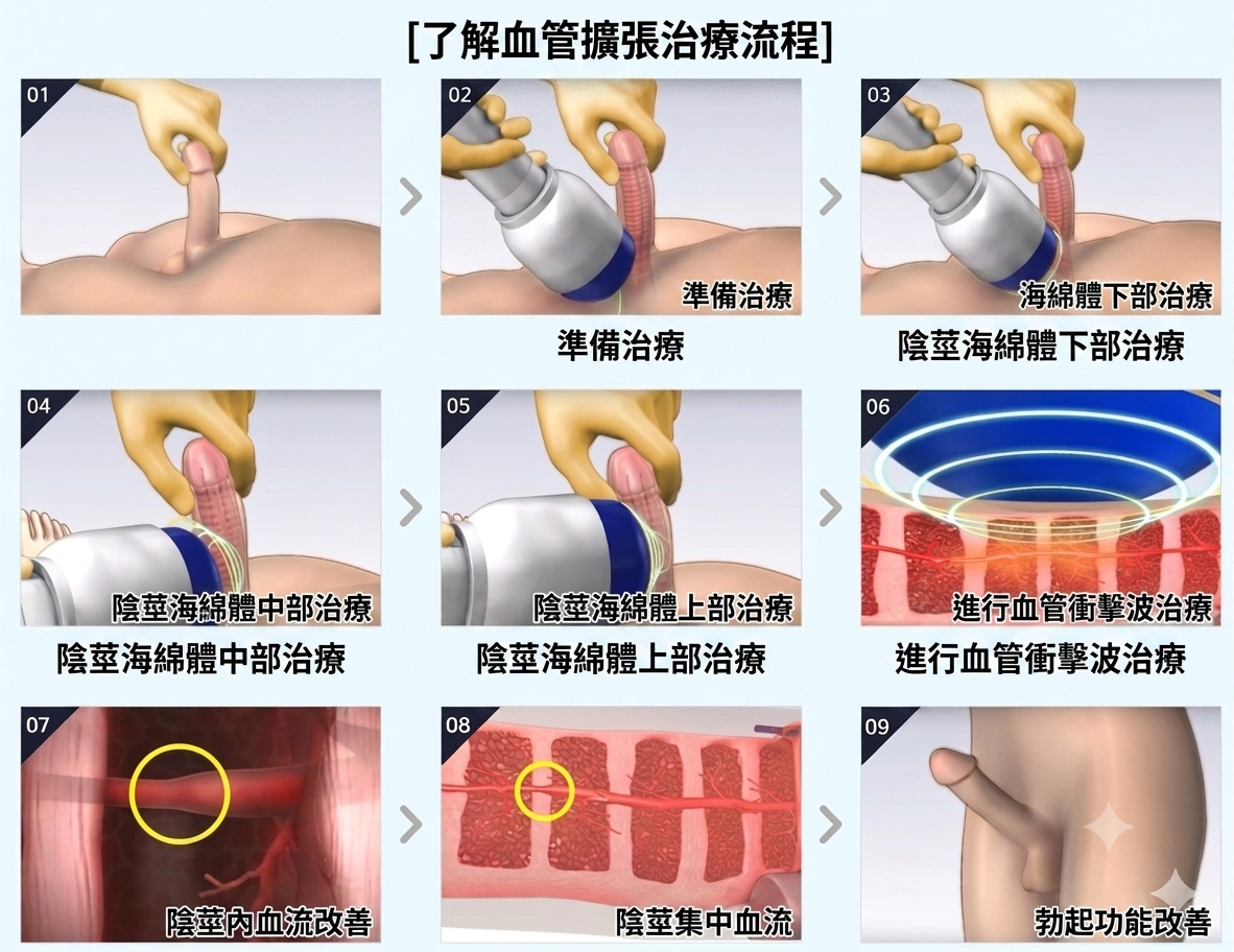 釜山西面 Urogyn 男科診所的 Li-ESWT 震波治療流程