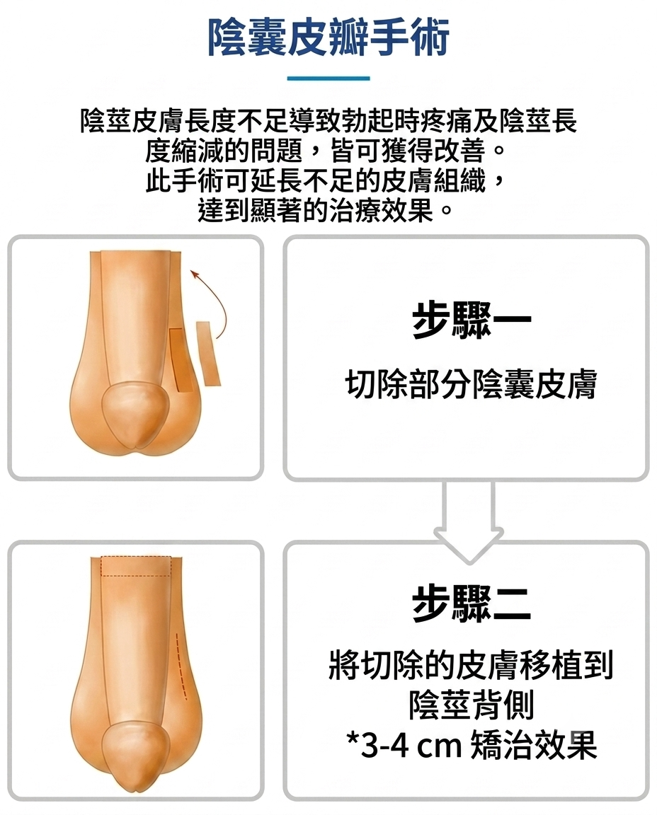 釜山西面 Urogyn 男科診所的陰囊皮瓣手術