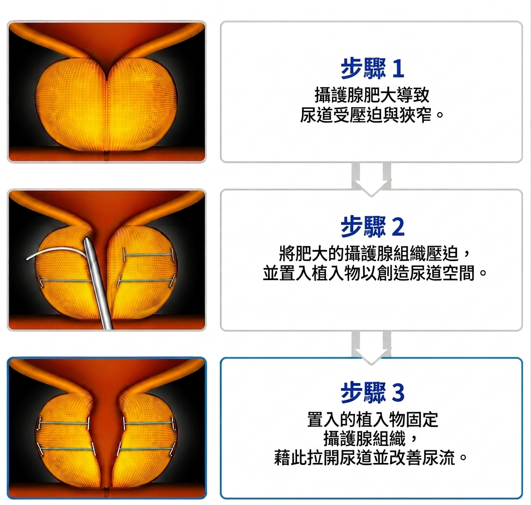 UroLift 術前術後——釜山 Urogyn 改善尿流