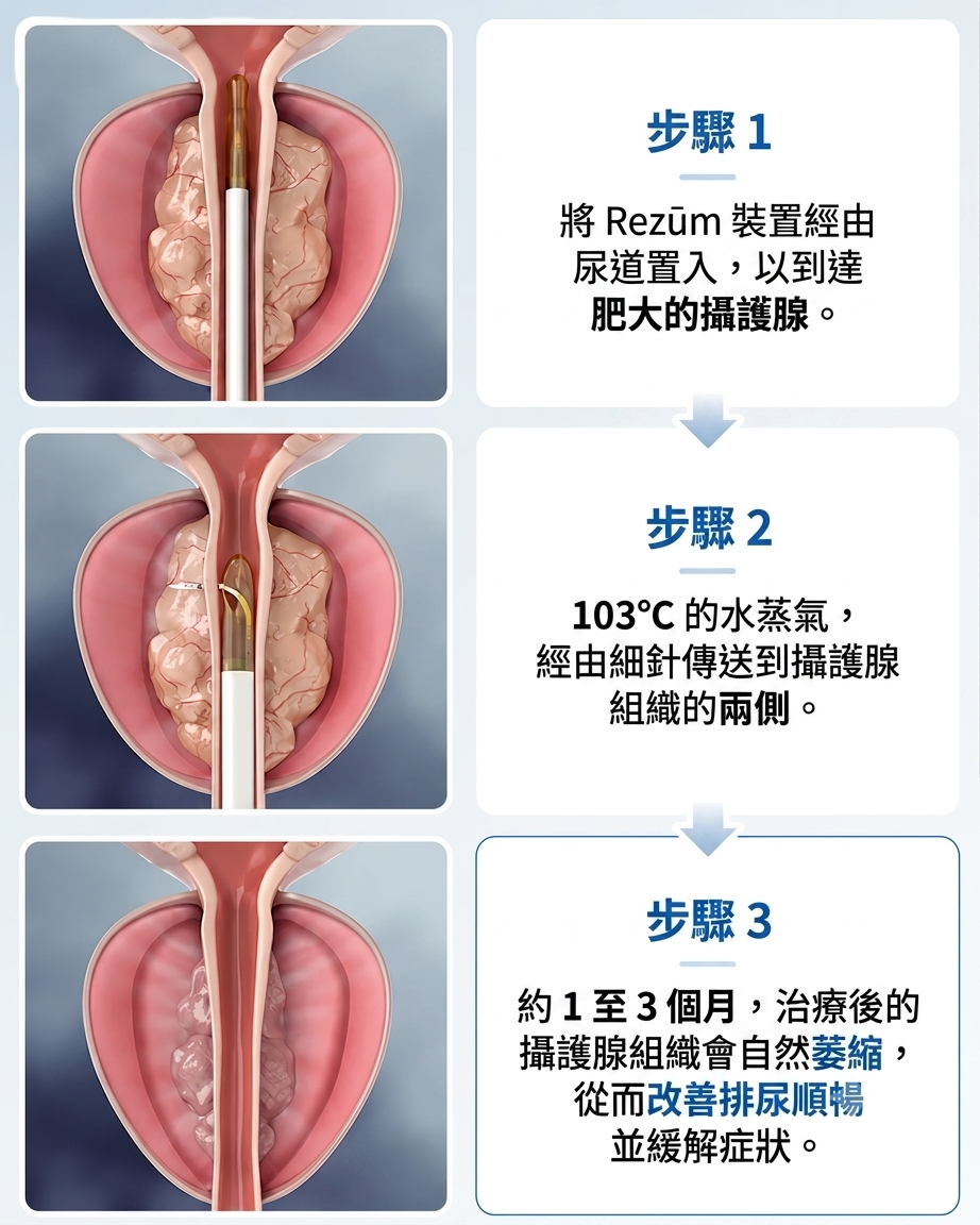 Rezum 術前術後——攝護腺體積縮小、尿道重新打開——釜山 Urogyn